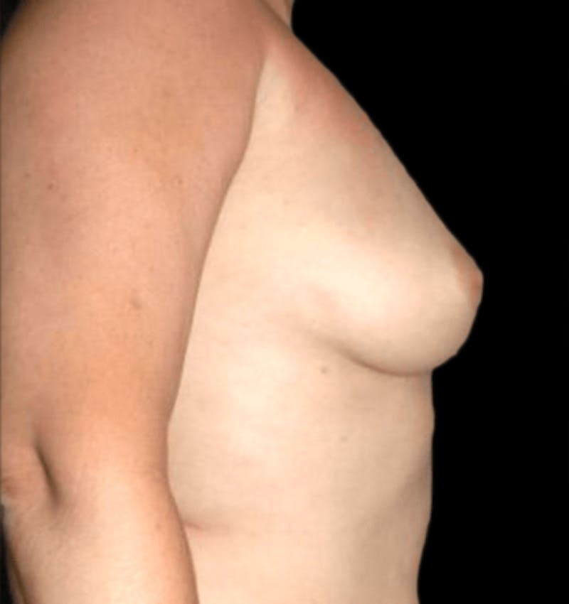 Breast Augmentation with Fat Grafting Before & After Gallery - Patient 215037 - Image 3