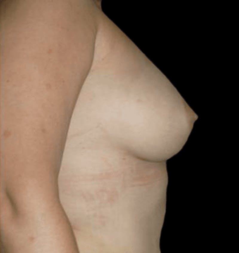 Breast Augmentation with Fat Grafting Before & After Gallery - Patient 215037 - Image 4