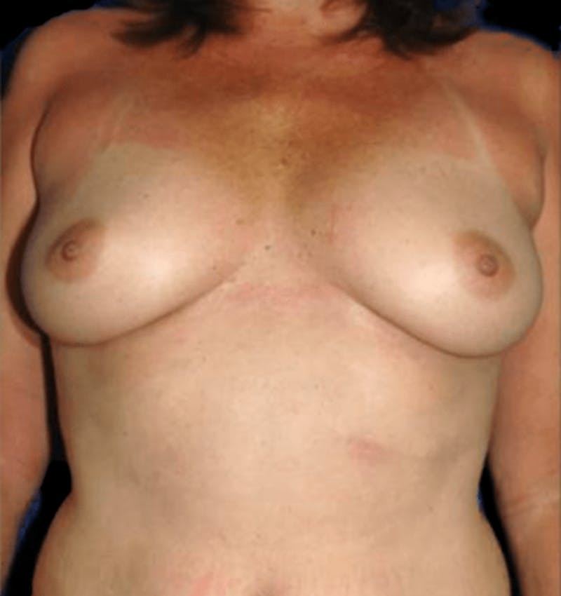 Breast Augmentation with Fat Grafting Before & After Gallery - Patient 215037 - Image 5