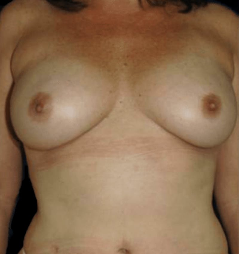 Breast Augmentation with Fat Grafting Before & After Gallery - Patient 215037 - Image 6
