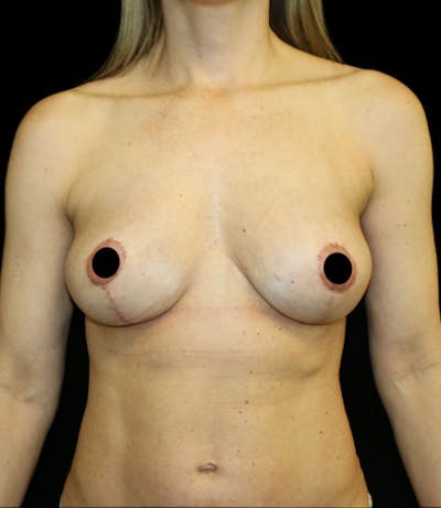 Breast Augmentation with Fat Grafting Before & After Gallery - Patient 191710 - Image 2