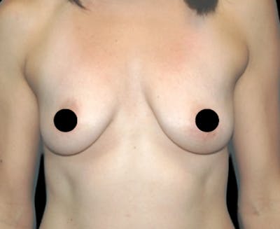 Breast Augmentation with Fat Grafting Before & After Gallery - Patient 208665 - Image 1