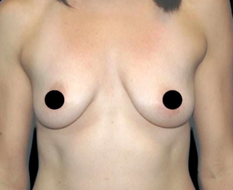 Breast Augmentation with Fat Grafting Before & After Gallery - Patient 208665 - Image 1