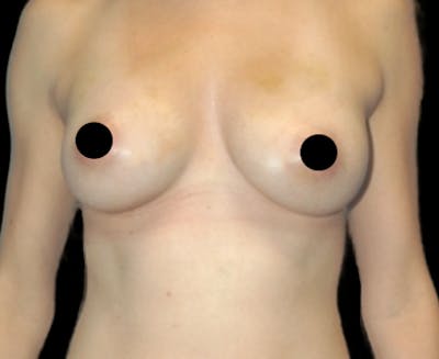 Breast Augmentation with Fat Grafting Before & After Gallery - Patient 208665 - Image 2