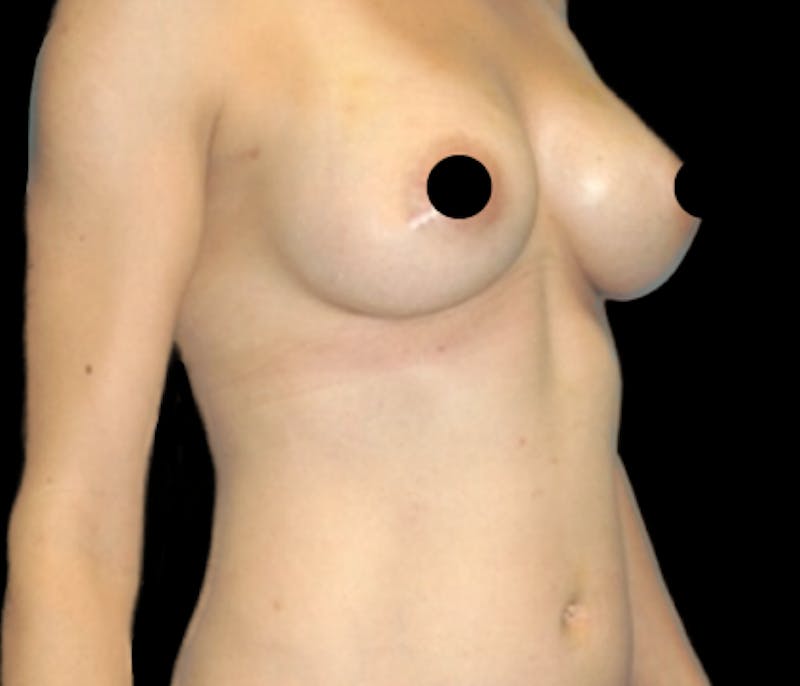 Breast Augmentation with Fat Grafting Before & After Gallery - Patient 208665 - Image 4