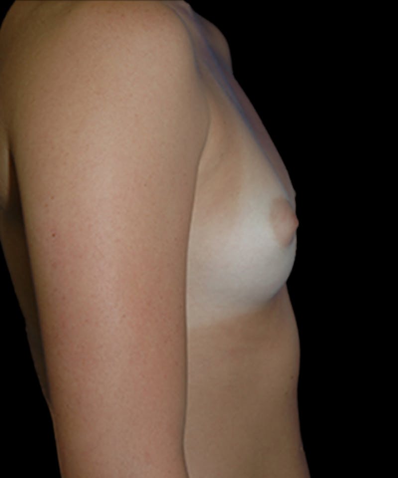 Breast Augmentation Before & After Gallery - Patient 175099 - Image 1