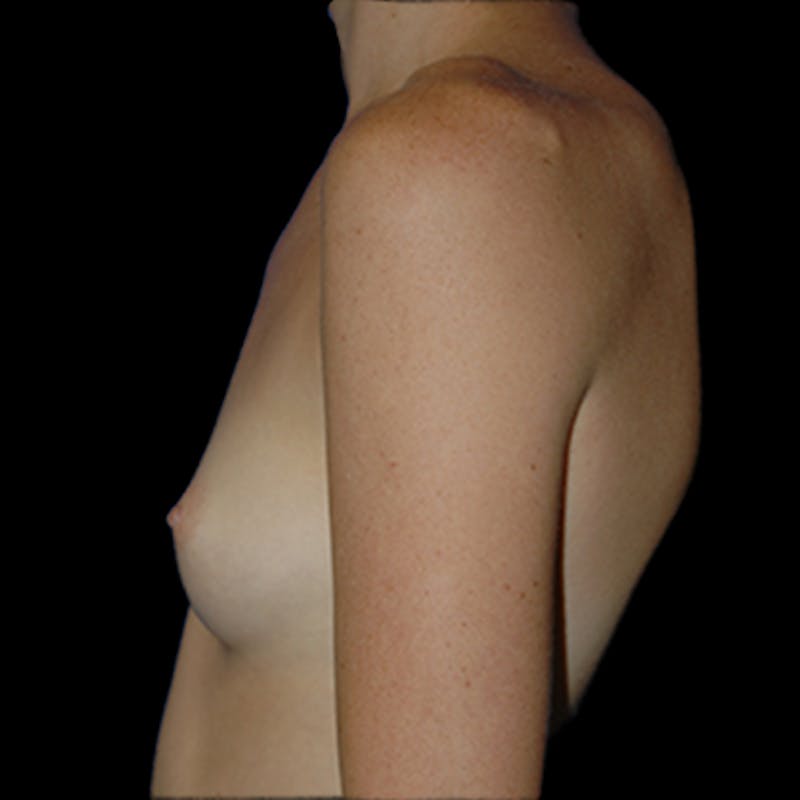 Breast Augmentation Before & After Gallery - Patient 324790 - Image 3