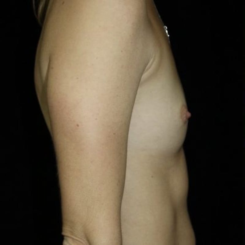 Breast Augmentation Before & After Gallery - Patient 184708 - Image 3