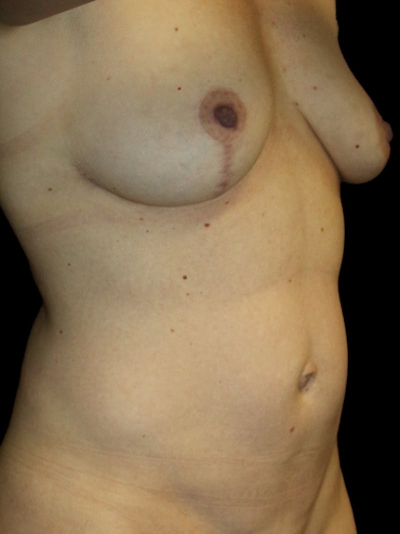 Abdominal Liposuction Before & After Gallery - Patient 454327 - Image 2