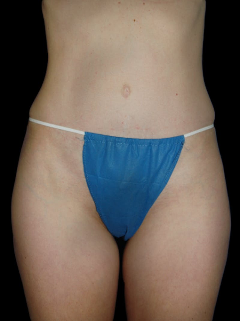 Mommy Makeover Before & After Gallery - Patient 241461 - Image 4