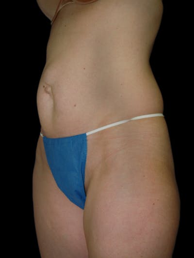 Mini Tummy Tuck Before & After Gallery - Patient 267660 - Image 1