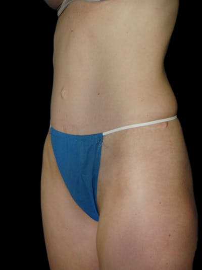 Mini Tummy Tuck Before & After Gallery - Patient 267660 - Image 2
