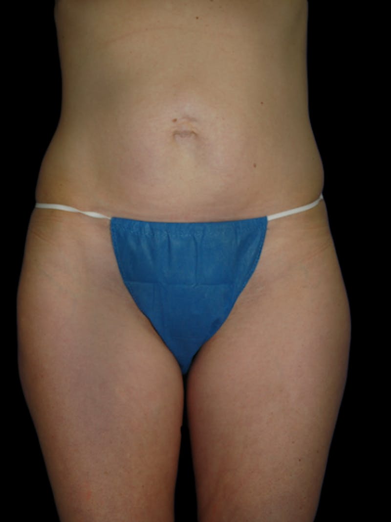 Mini Tummy Tuck Before & After Gallery - Patient 267660 - Image 3