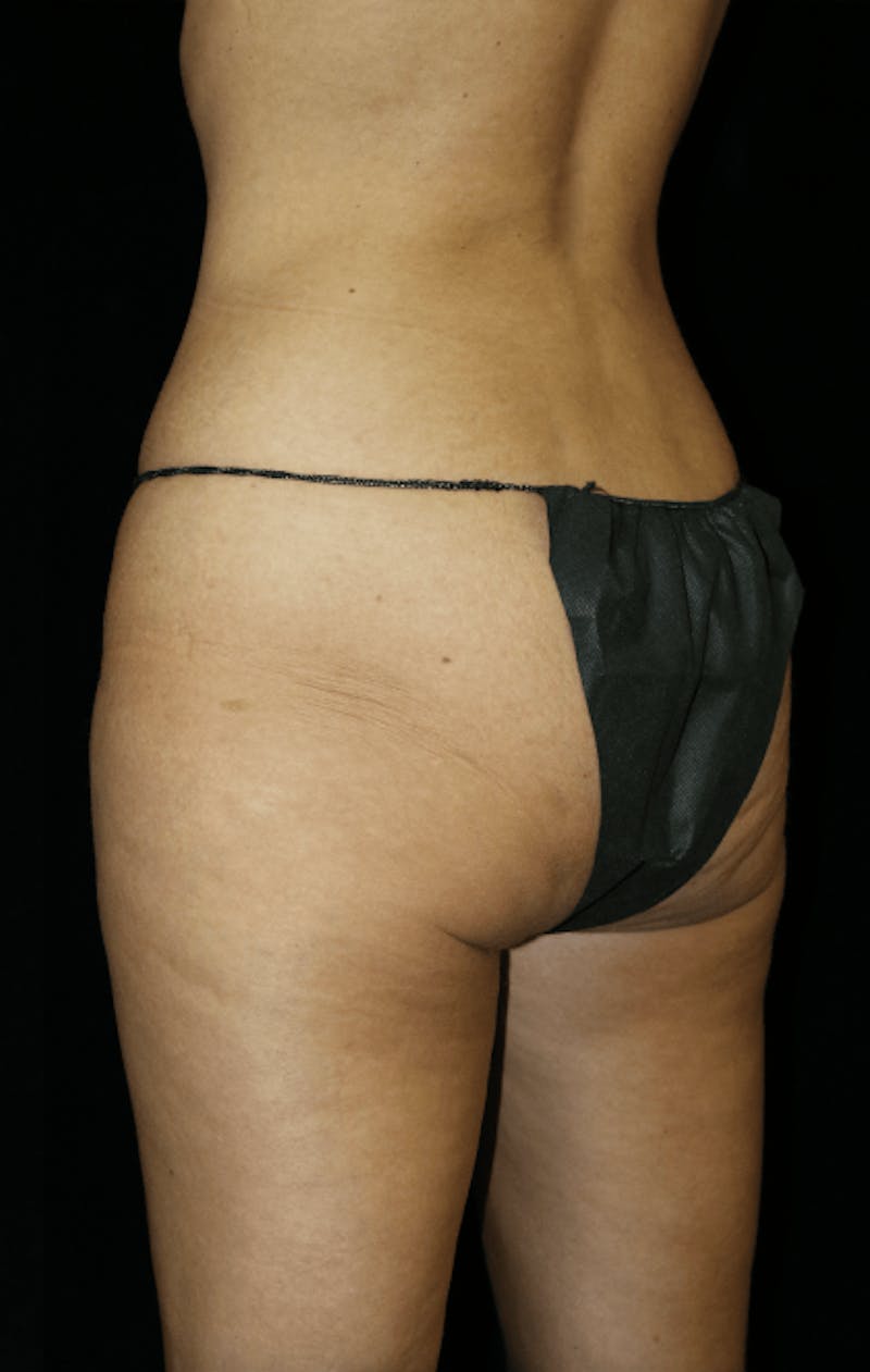 Brazilian Butt Lift Before & After Gallery - Patient 144335 - Image 1
