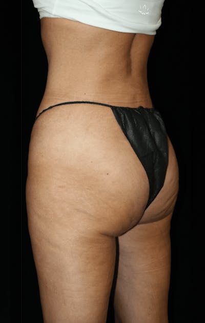 Brazilian Butt Lift Before & After Gallery - Patient 144335 - Image 2