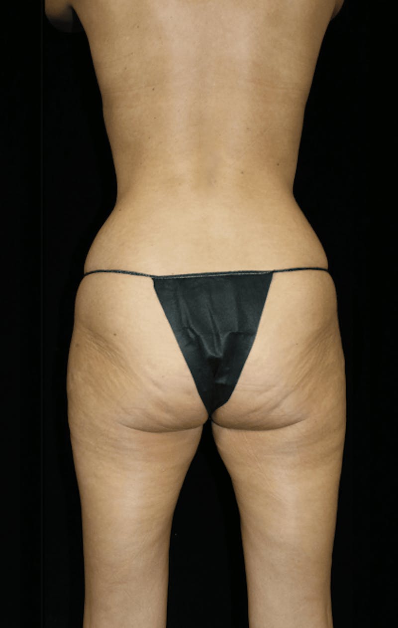 Brazilian Butt Lift Before & After Gallery - Patient 144335 - Image 3