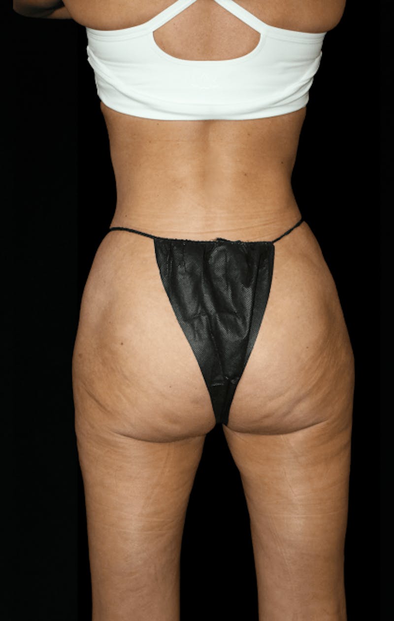 Brazilian Butt Lift Before & After Gallery - Patient 144335 - Image 4