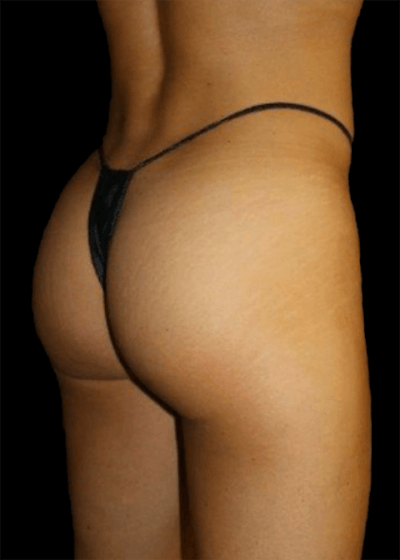 Brazilian Butt Lift Before & After Gallery - Patient 101265 - Image 1
