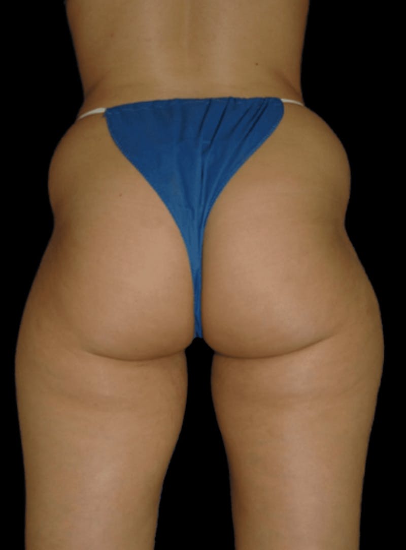 Brazilian Butt Lift Before & After Gallery - Patient 129711 - Image 1