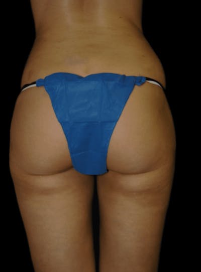 Brazilian Butt Lift Before & After Gallery - Patient 129711 - Image 2