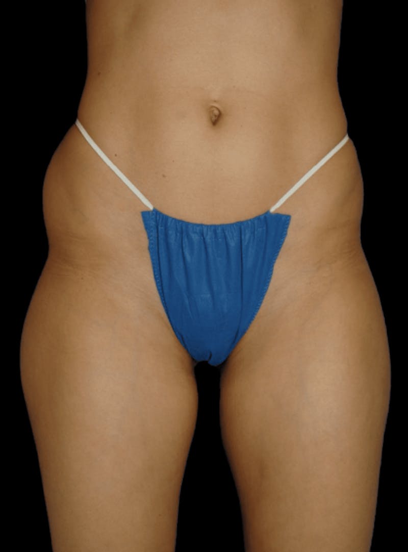 Brazilian Butt Lift Before & After Gallery - Patient 129711 - Image 3