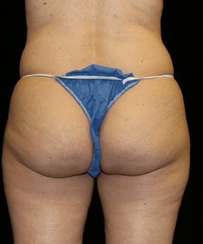 Brazilian Butt Lift Before & After Gallery - Patient 862877 - Image 1