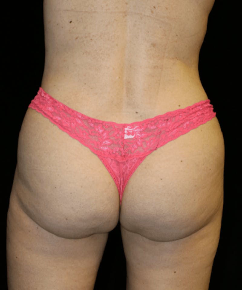 Brazilian Butt Lift Before & After Gallery - Patient 862877 - Image 2