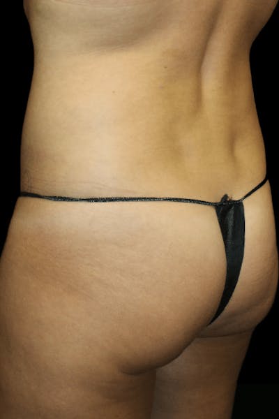 Brazilian Butt Lift Before & After Gallery - Patient 886121 - Image 1