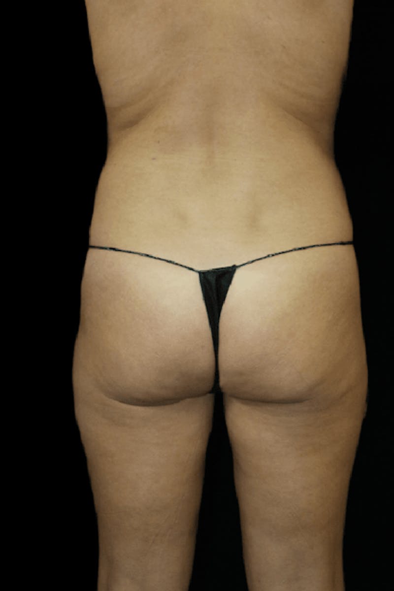 Brazilian Butt Lift Before & After Gallery - Patient 886121 - Image 3