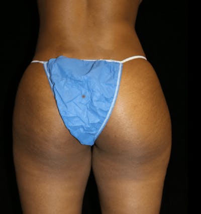 Brazilian Butt Lift Before & After Gallery - Patient 184053 - Image 2