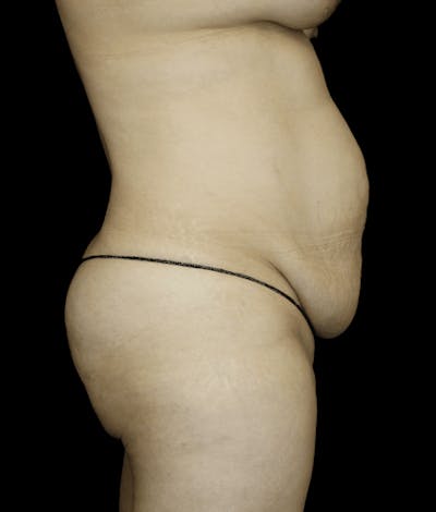 Tummy Tuck Before & After Gallery - Patient 418568 - Image 1