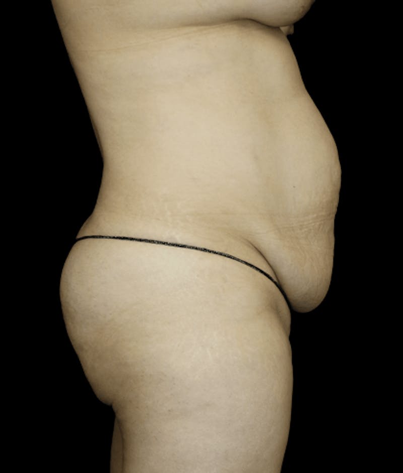 Tummy Tuck Before & After Gallery - Patient 418568 - Image 1