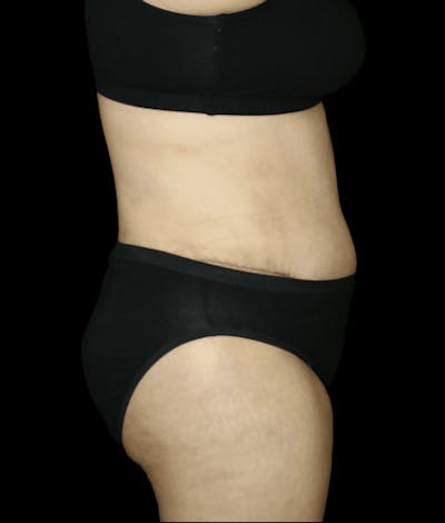 Tummy Tuck Before & After Gallery - Patient 418568 - Image 2