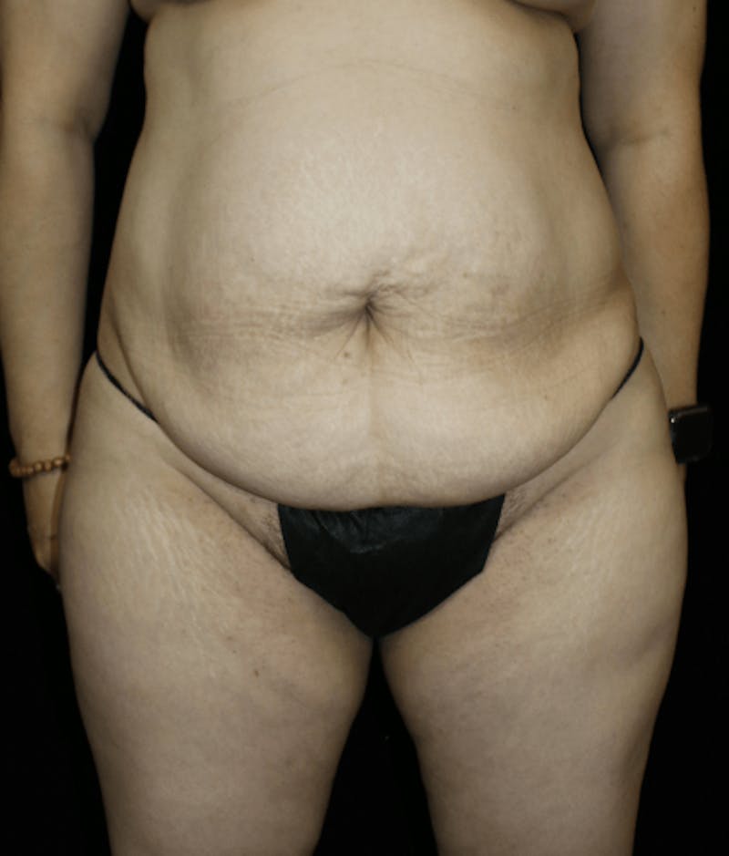 Tummy Tuck Before & After Gallery - Patient 418568 - Image 3