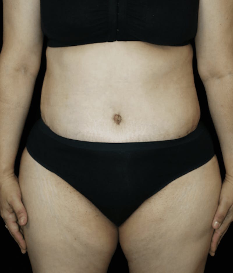 Tummy Tuck Before & After Gallery - Patient 418568 - Image 4