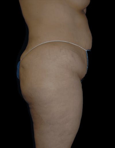 Tummy Tuck Before & After Gallery - Patient 206676 - Image 1