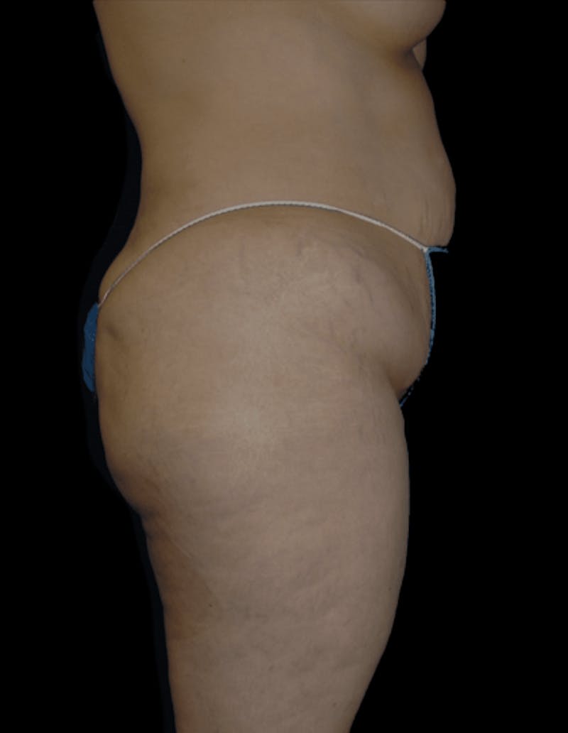 Tummy Tuck Before & After Gallery - Patient 206676 - Image 1