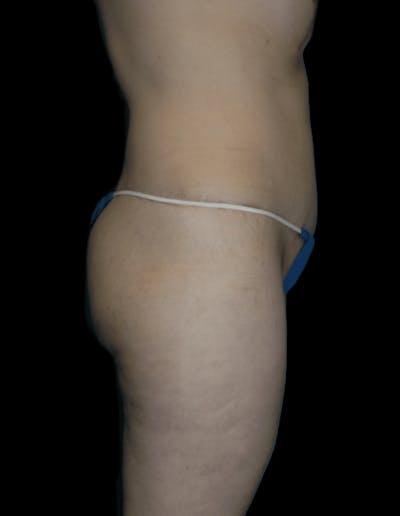 Tummy Tuck Before & After Gallery - Patient 206676 - Image 2