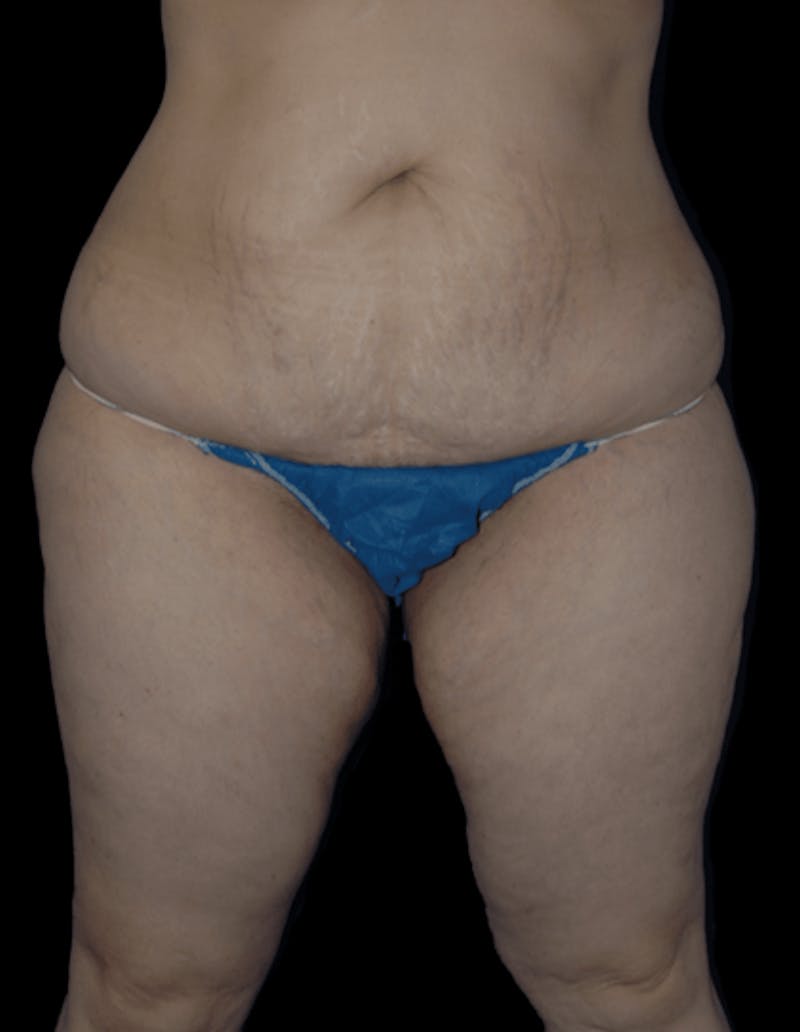 Tummy Tuck Before & After Gallery - Patient 206676 - Image 3