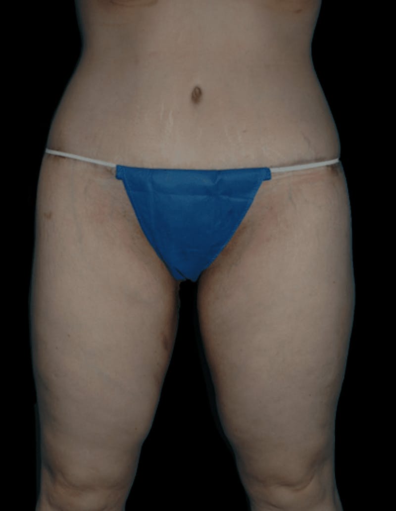 Tummy Tuck Before & After Gallery - Patient 206676 - Image 4