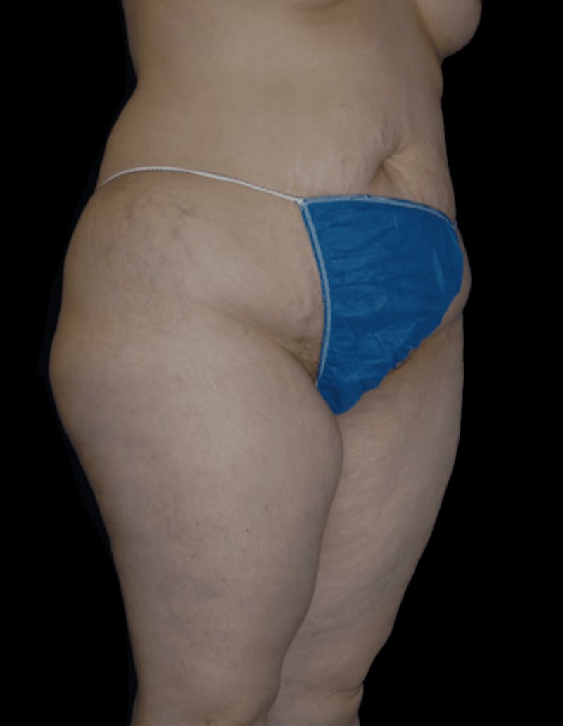 Tummy Tuck Before & After Gallery - Patient 206676 - Image 5