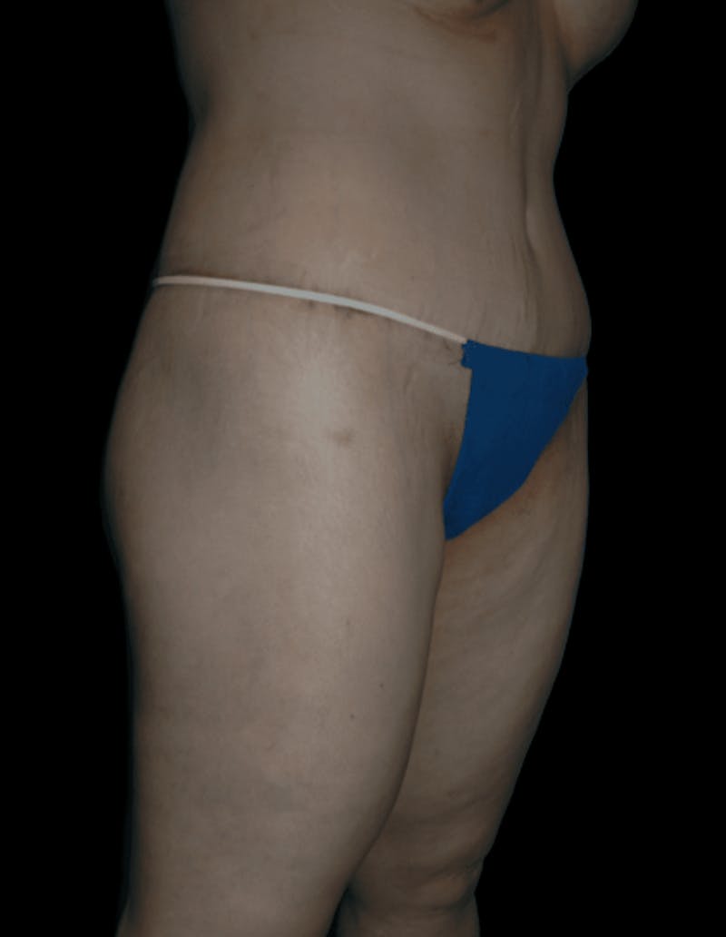 Tummy Tuck Before & After Gallery - Patient 206676 - Image 6
