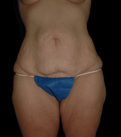 Tummy Tuck Before & After Gallery - Patient 432016 - Image 1