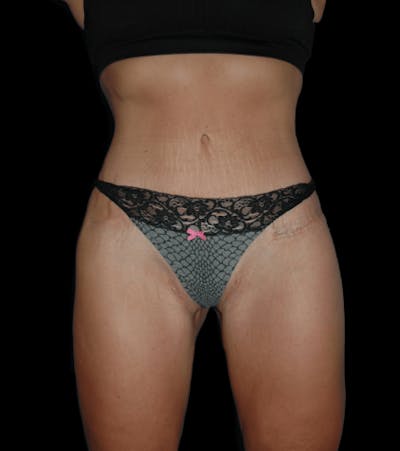Tummy Tuck Before & After Gallery - Patient 432016 - Image 2