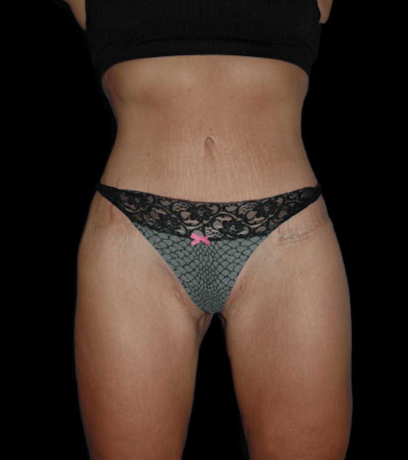 Tummy Tuck Before & After Gallery - Patient 432016 - Image 2