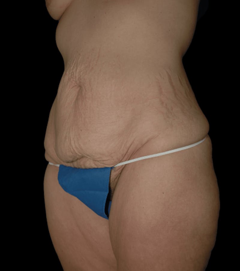 Tummy Tuck Before & After Gallery - Patient 432016 - Image 3