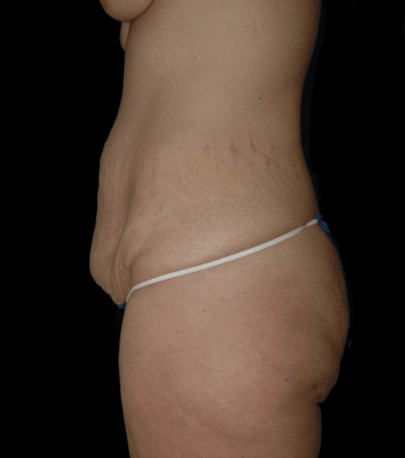 Tummy Tuck Before & After Gallery - Patient 432016 - Image 5