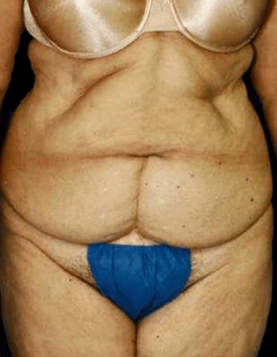 Tummy Tuck Before & After Gallery - Patient 224091 - Image 1