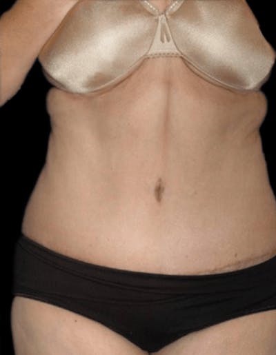 Tummy Tuck Before & After Gallery - Patient 224091 - Image 2