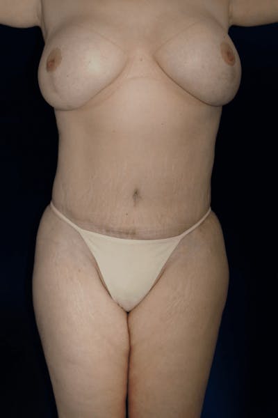 Tummy Tuck Before & After Gallery - Patient 281793 - Image 2